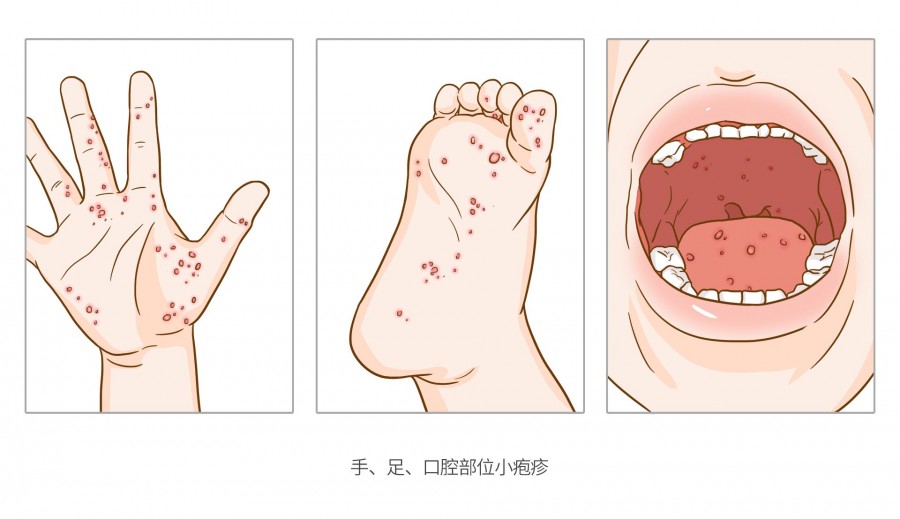 일본에서 가장 전염성이 강한 14가지 질병과 가장 많은 사람들을 죽이는 질병