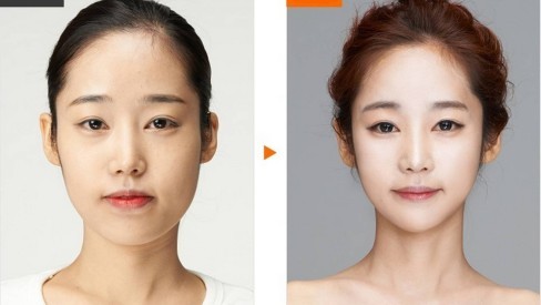 Koreans get plastic surgery as a gift?